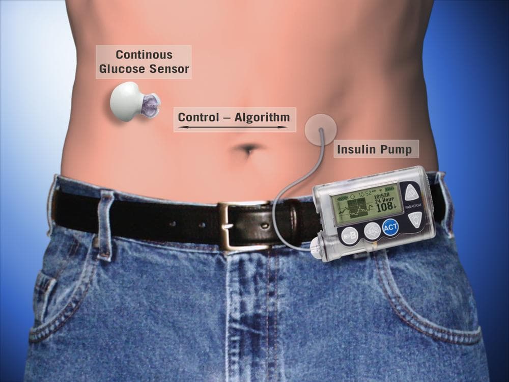 How An Artificial Pancreas Works Here & Now