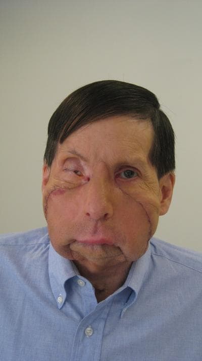 James Maki of Massachusetts is the first person in New England to receive a partial face transplant. (Photo courtesy of Brigham And Women's Hospital)