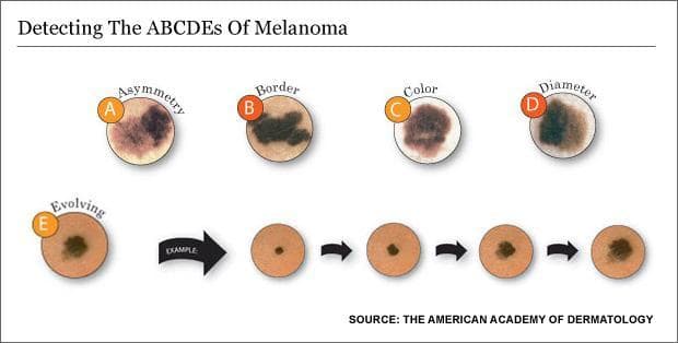     When looking at a spot on the skin that might be melanoma, the American Academy of Dermatology recommends following the ABCDE rules. (WBUR)
