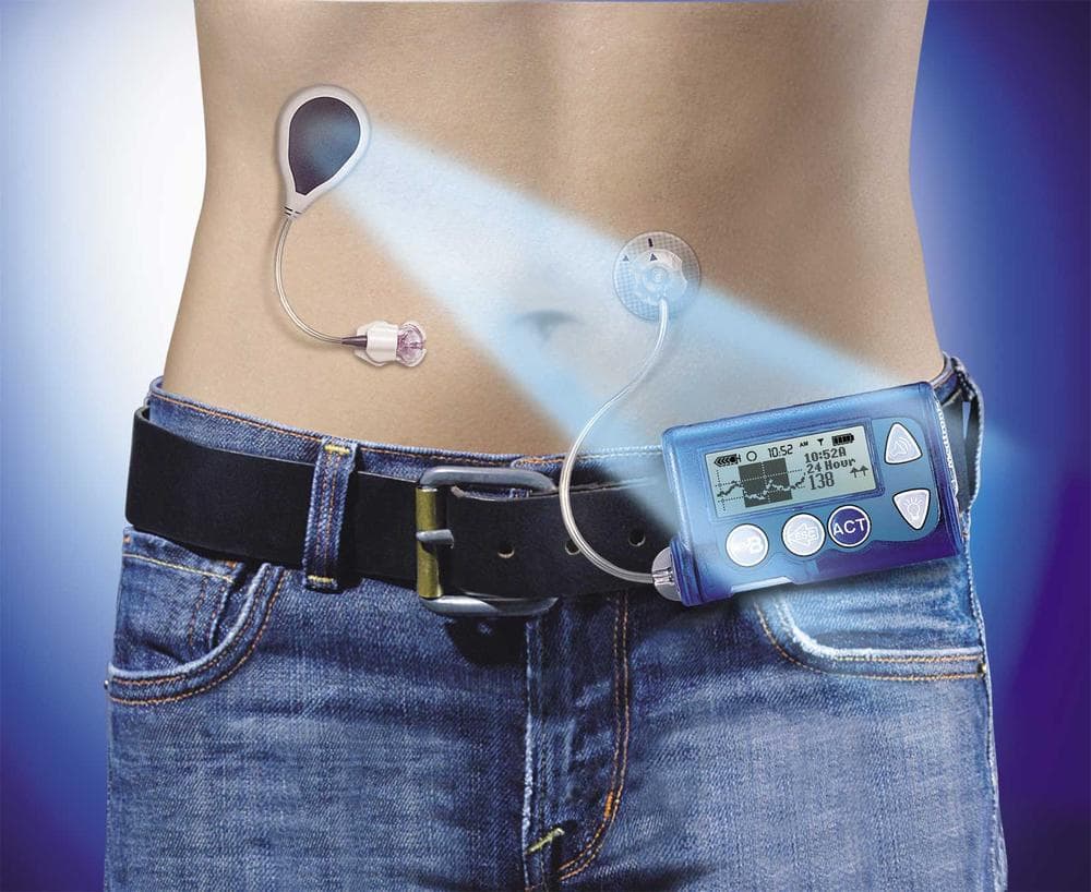 An image of an artificial pancreas, envisioned by the Juvenile Diabetes Research Foundation.
