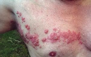 Ouch. A case of shingles, also known as herpes zoster