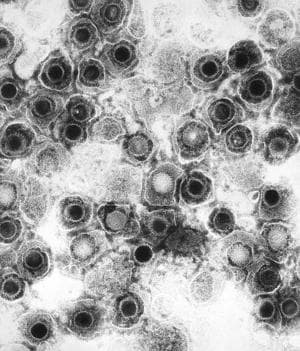 A lab image of herpes virus