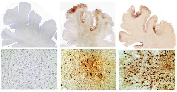CASE STUDY: Sections from the medial temporal lobe of three individuals. At left is a 65-year-old control subject, at center is former NFLer John Grimsley and at right is a 73-year-old champion boxer with severe dementia. The bottom images are microscopic sections of the top images. The control shows no sign of tau protein build-up, Grimsley shows significant build-up and the boxer shows extreme build-up. (CSTE) 