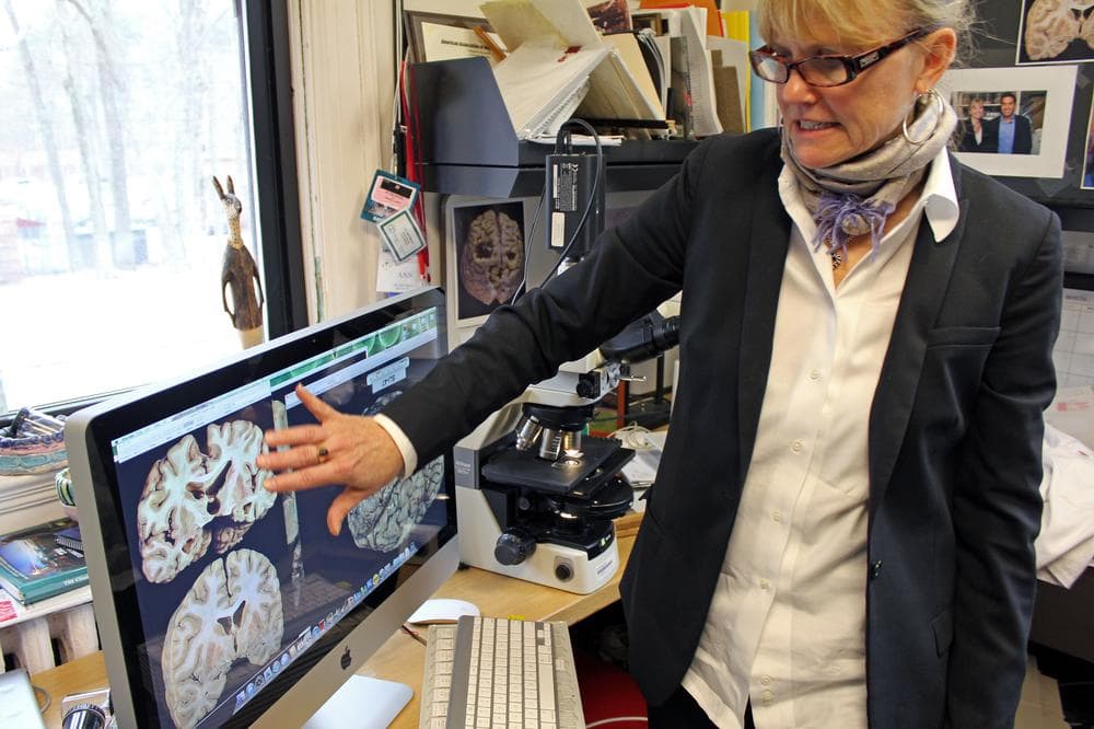 Dr. Ann McKee, co-founder of Boston University&#039;s Center for the Study of Traumatic Encephalopathy, points to images of brains with signs of the degenerative brain disease. (Lisa Tobin/WBUR)