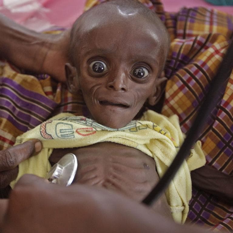 Mihag Gedi Farah, a seven-month-old child with a weight of 3.4kg, is held by his mother in a field hospital of the International Rescue Committee, IRC, in the town of Dadaab, Kenya, Tuesday, July 26, 2011. (AP)