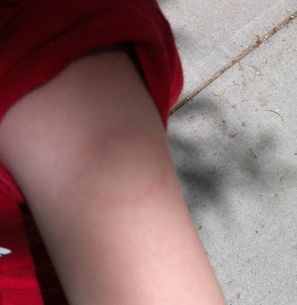A classic Lyme Disease &quot;bullseye&quot; on my son&#39;s arm