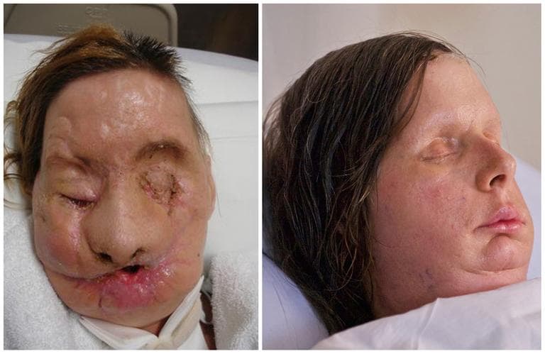 Undated photos provided by Brigham and Women’s Hospital show chimpanzee attack victim Charla Nash after the attack, left, and post-face transplant surgery. (AP)