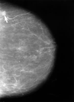 A mammogram image, with arrow in upper left pointing to cancer