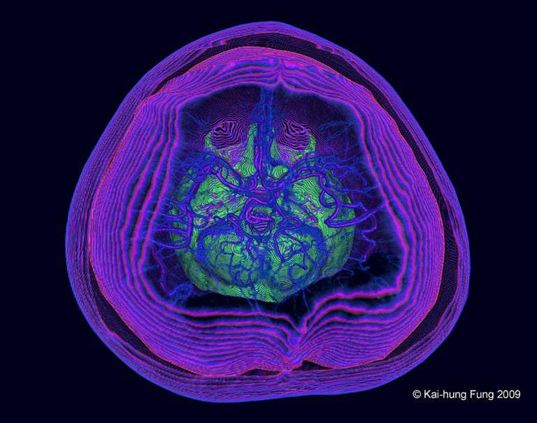 This rendered 3-D computed tomography (CT) scan looking down the human head shows the complicated arteries and veins (in blue) supplying the brain above the base of the skull (in green). (Kai-hung Fung/National Science Foundation)