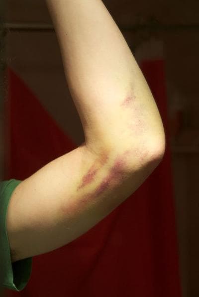 Eric Herot&#039;s injured elbow (Courtesy)