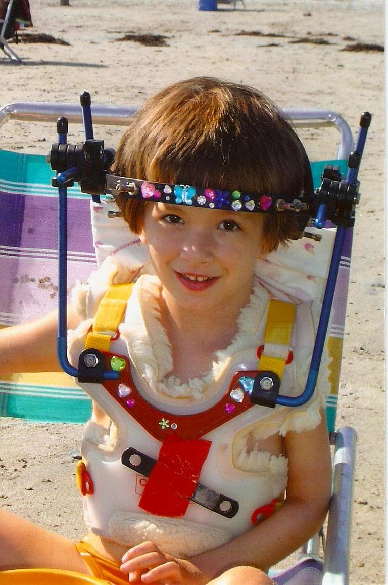 Riley wearing the &quot;Halo&quot; after the spinal fusion surgery in 2006. (Courtesy: Kristen Davis)