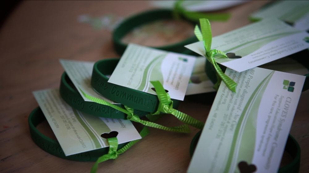 Green fundraising bracelets for the CLOVES Syndrome Community prepared by Kristen Davis to be sent out to donors. (Jesse Costa/WBUR)