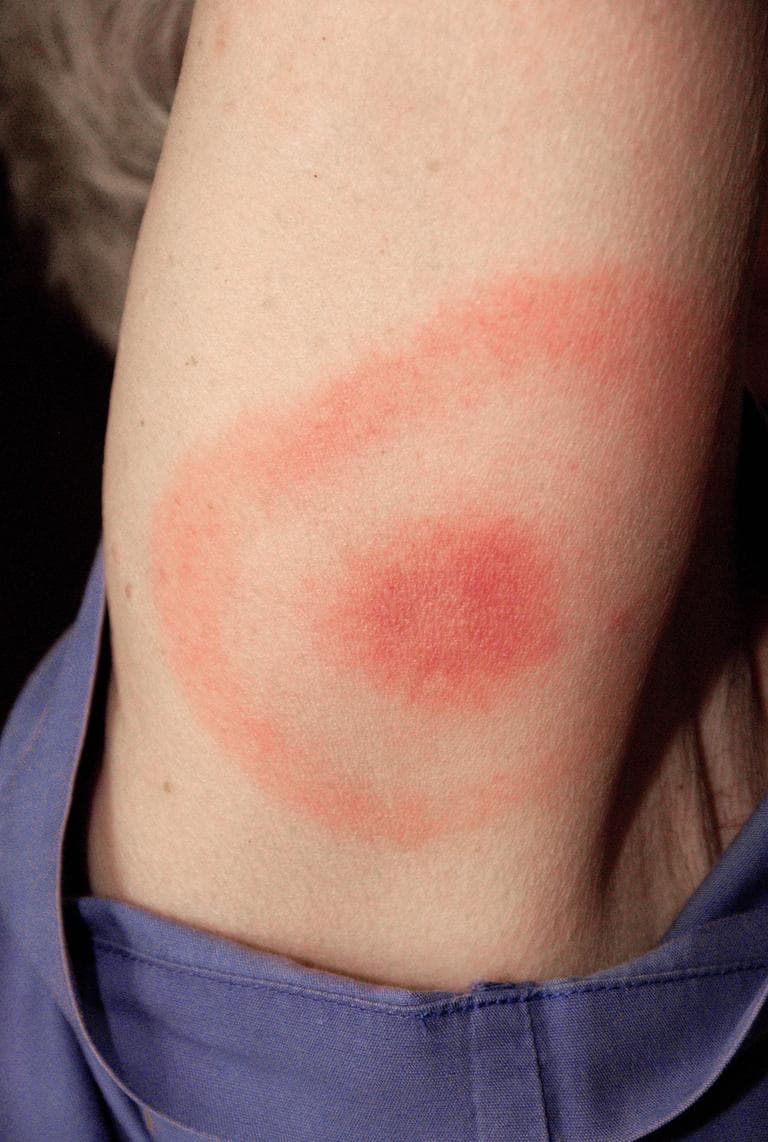 In this photo released by the Centers for Disease Control and Prevention, the rash in the pattern of a “bull’s-eye” manifested at the site of a tick bite. (AP)