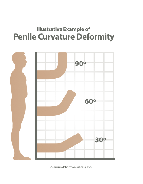 Penis curved to right