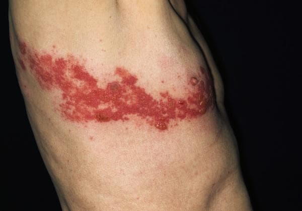 Shingles rash on the chest of a 90-year-old man (Courtesy of Merck)
