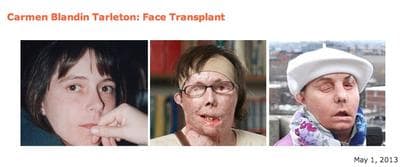 Photos from Brigham &amp; Women's Hospital of its latest face transplant recipient, Carmen Blandin Tarleton. (Courtesy BWH)