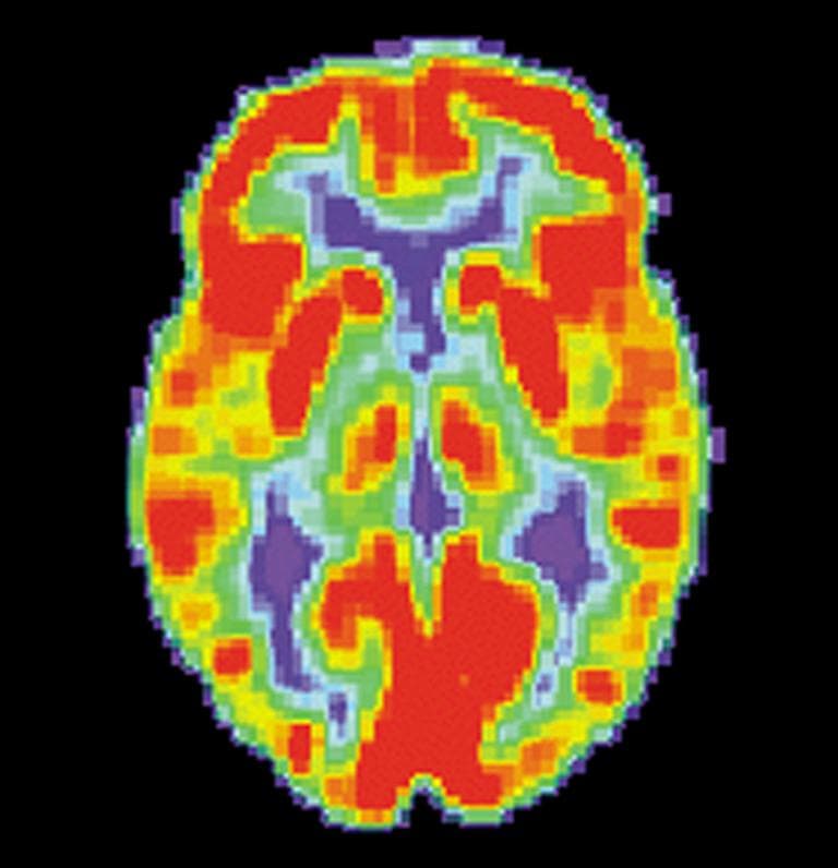 PET scan of a normal brain (NIA/Wikimedia Commons)