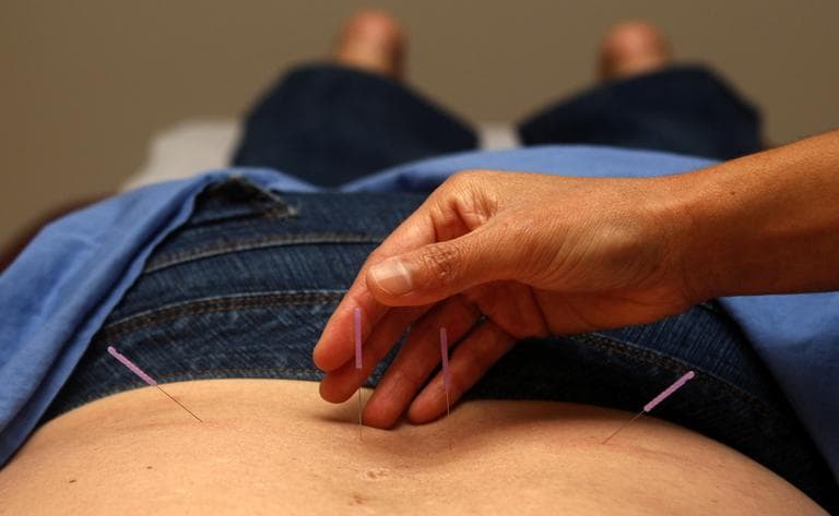 This Oct. 28, 2009 photo shows Christine Kinsella, a licensed acupuncturist and Chinese Herbalist, treating patient Cynde Durnford-Branecki during an acupuncture treatment in San Diego. (Lenny Ignelzi/AP)