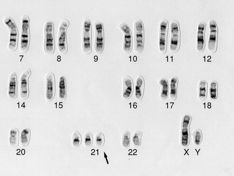 Down syndrome human karyotype (Wessex Reg. Genetics Centre)