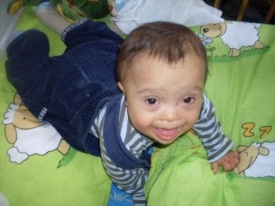 A 1-year-old with Down syndrome (Wikimedia Commons)