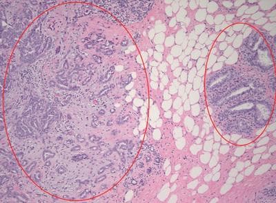 The right smaller circle is normal breast tissue. The left are the donut-shaped glands, with white centers, that are the telltale signs of an invasive breast cancer. (Image courtesy Michael Misialek) 
