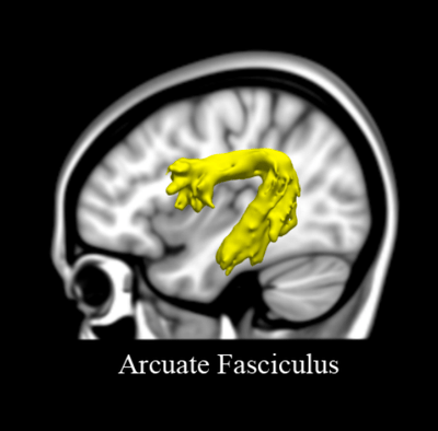 The area highlighted in yellow, called the arcuate fasciculus, is less robust in children at high risk for dyslexia, according to a new study. 