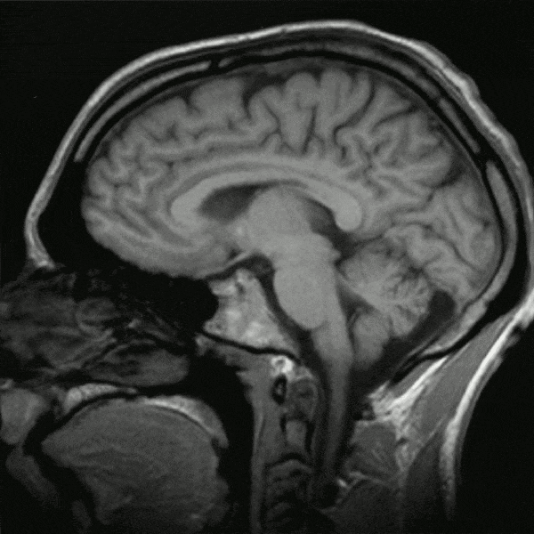 An MRI scan of the human brain. (Wikipedia)