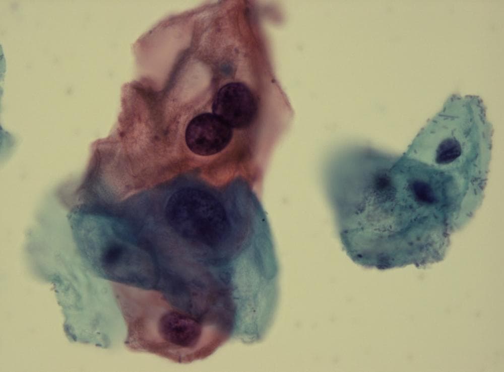 A pap smear shows cervical cells infected by human papilloma virus (Michael Misialek)