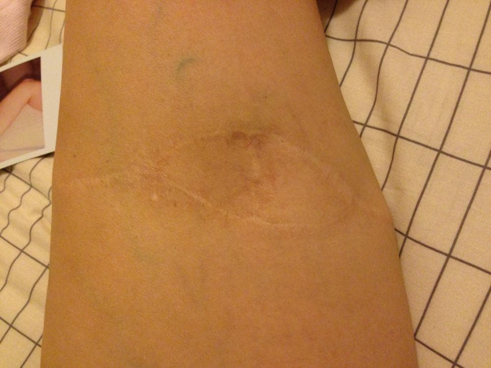 The scar left on Alicair Peltonen's leg (Courtesy)