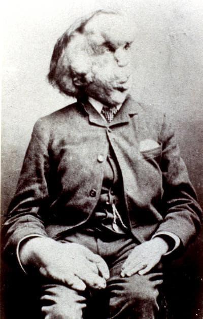 Joseph Merrick, Victorian England's famous &quot;Elephant Man,&quot; is shown in a photo from the Radiological Society of North America. (AP)