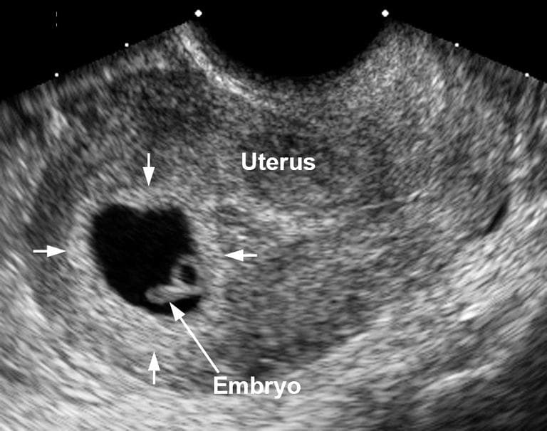 Can Ectopic Pregnancy Be Misdiagnosed? 