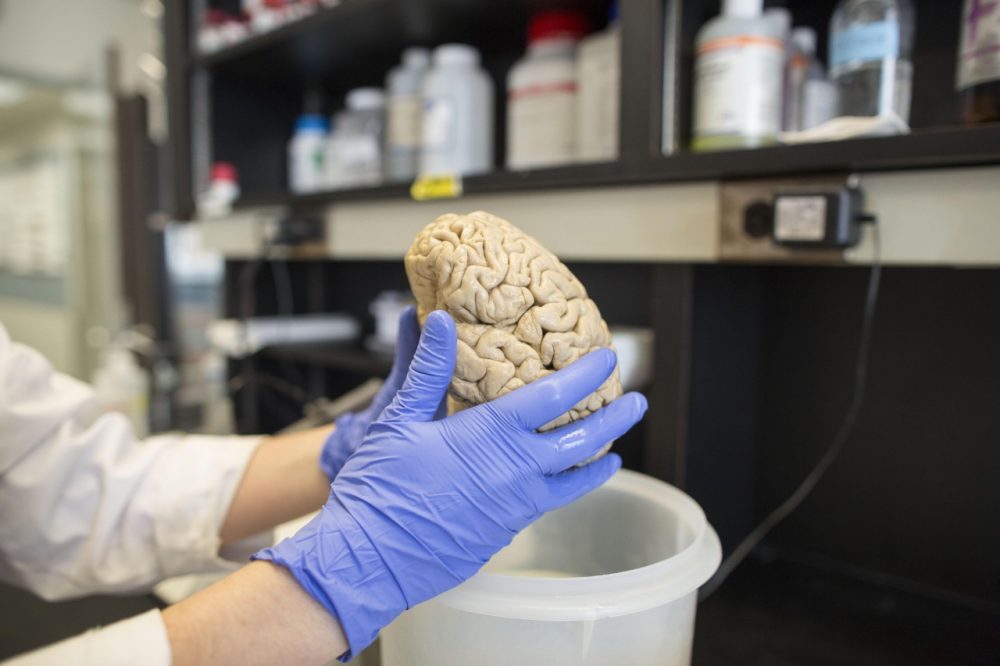 A researcher holds a human brain in a laboratory at Northwestern University's cognitive neurology and Alzheimer's disease center in Chicago. (Scott Eisen/AP)