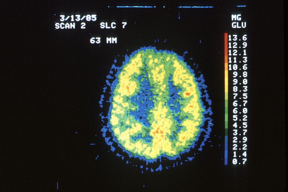 Position emission tomography (PET) scan of a normal brain. (Wikimedia Commons/National Cancer Institute)