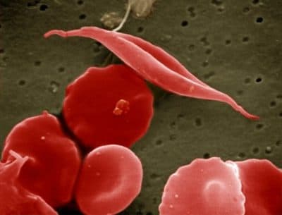 A &quot;sickled&quot; cell among normal red blood cells. (Wikimedia Commons)
