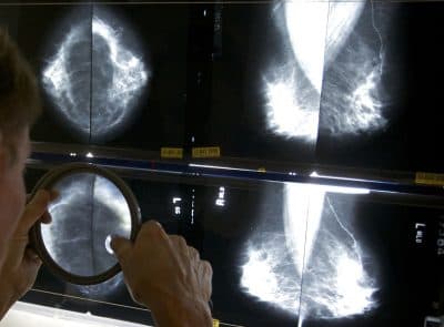 In this file photo, a radiologist uses a magnifying glass to check mammograms for breast cancer in Los Angeles. (Damian Dovarganes/AP/File)