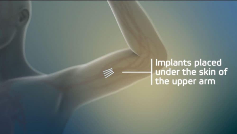 A graphic shows how the implant is placed inside the skin of a person's upper arm. (Courtesy Braeburn Pharmaceuticals)