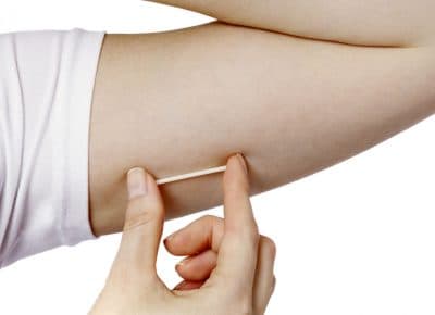 A Nexplanon birth control hormonal implant. (Merck/AP)