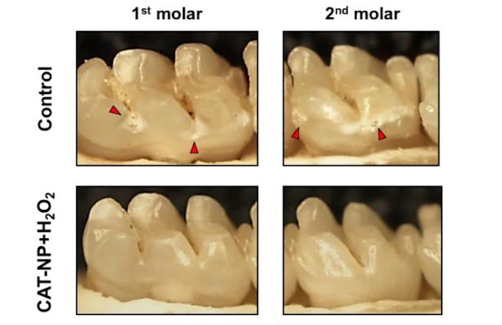 An iron oxide nanoparticle applied to teeth prior to treatment with hydrogen peroxide effectively reduced the onset and severity of cavities (indicated with red arrows) in rats.
(Courtesy University of Pennsylvania)
