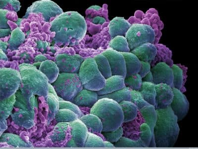 A cluster of breast cancer cells showing visual evidence of programmed cell death, in purple. (Annie Cavanagh/Wellcome Images)