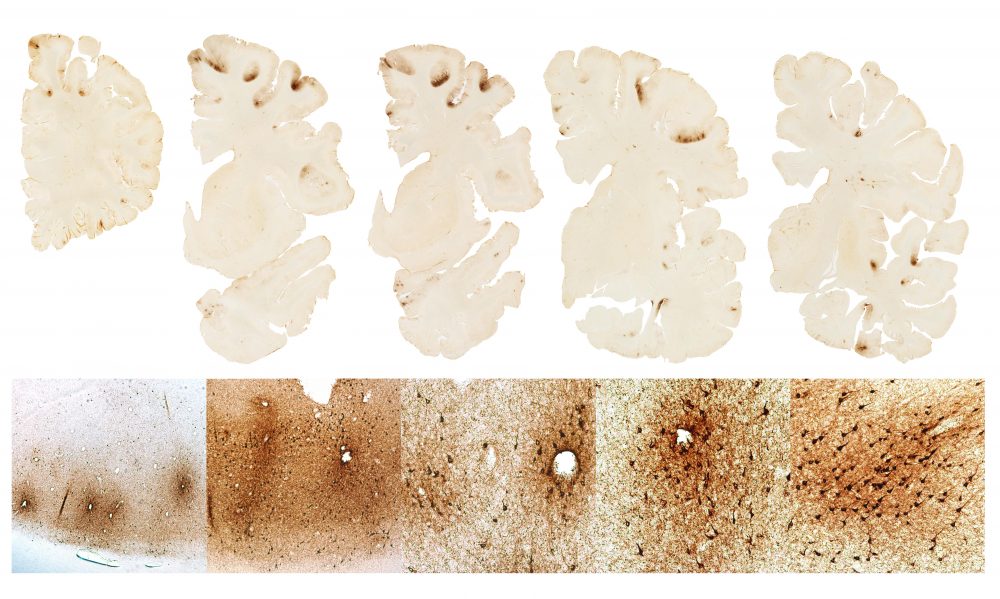 This graphic, BU researchers say, shows the classic features of CTE in the brain of. Hernandez. (Courtesy BU CTE Center)