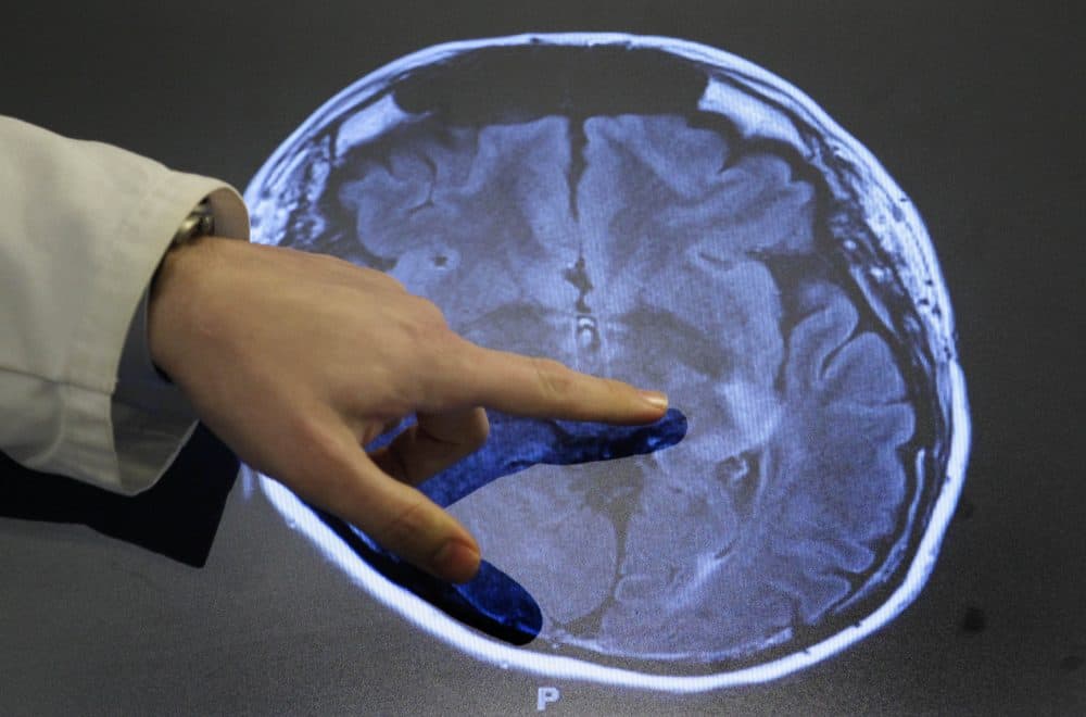 A doctor points to spots of possible damage caused by a stroke on a brain scan at Johns Hopkins Hospital in Baltimore. (Patrick Semansky/AP)