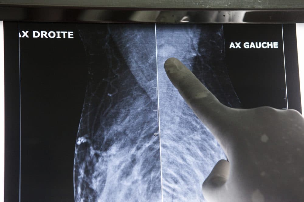 Dr. Abdoul Aziz Kasse looks at a mammogram that shows signs of cancer in his office at the Clinique des Mamelles in Dakar, Senegal, on July 13, 2017. (Jane Hahn/AP)
