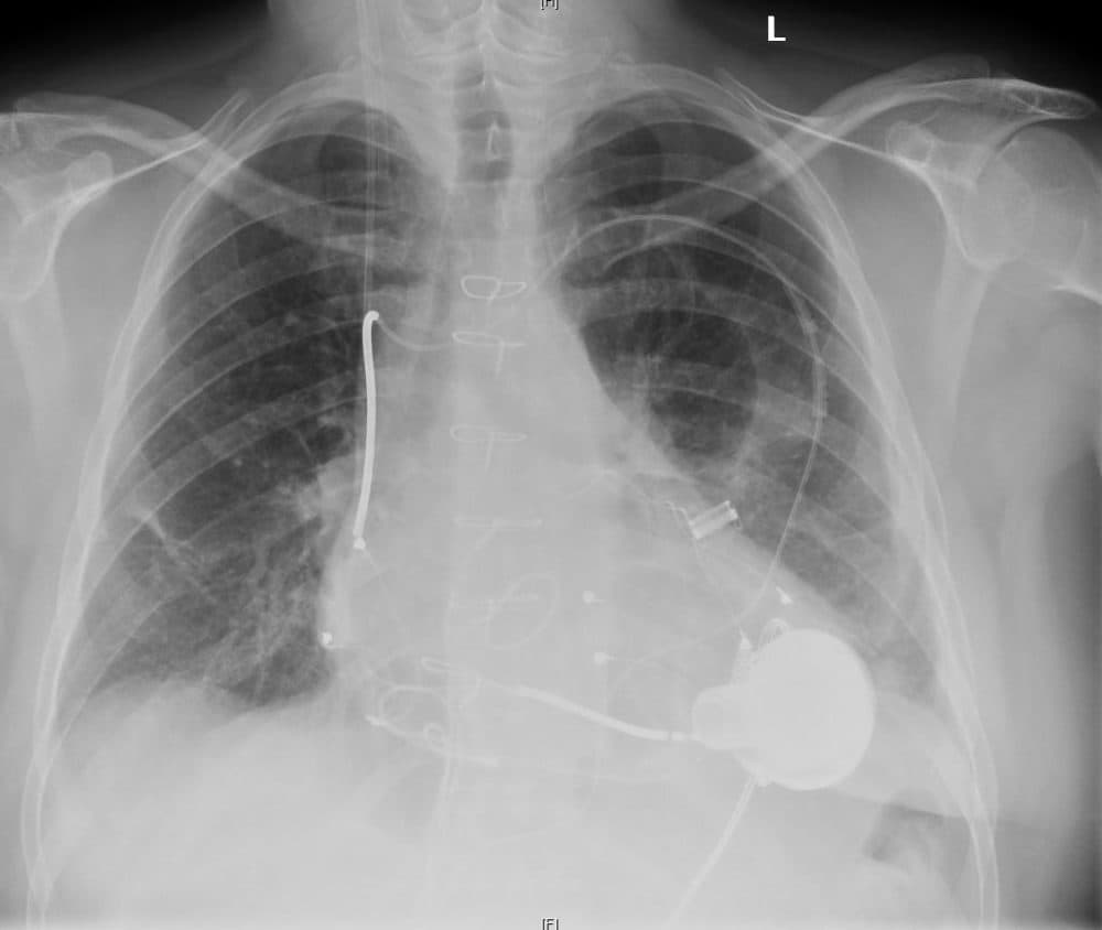 An X-Ray after the implantation of an LVAD heart device (7asmin via Wikimedia Commons)