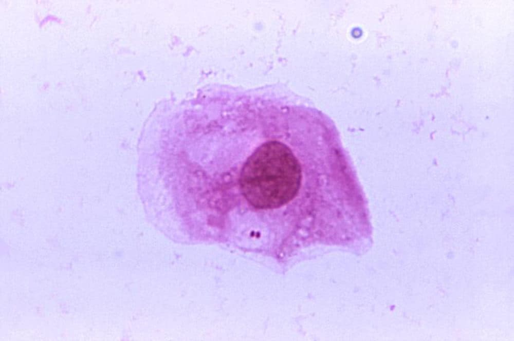 A photomicrograph of meningococcal disease. (Courtesy CDC)