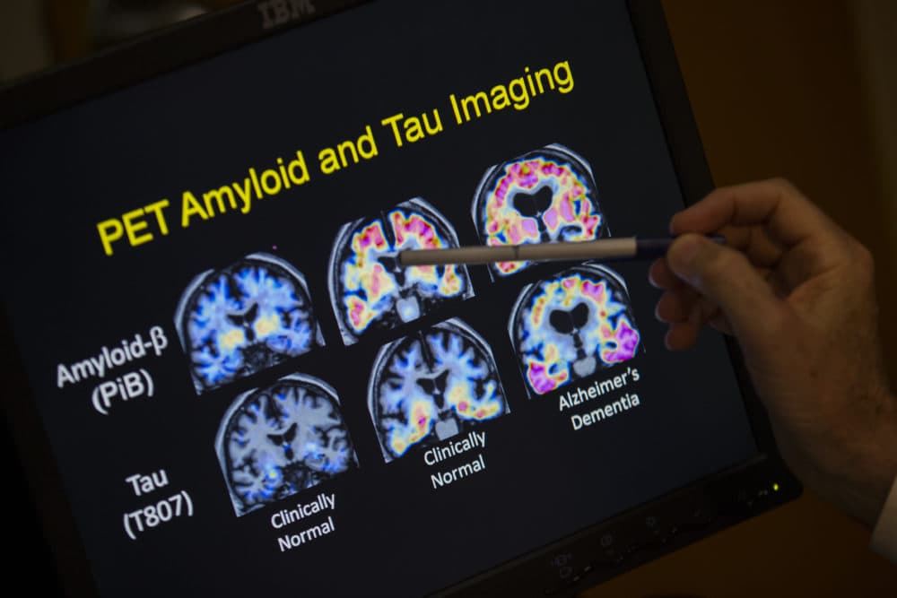 Tau and amyloid proteins are visible on brain scans in this 2015 file photo. (Evan Vucci/AP)