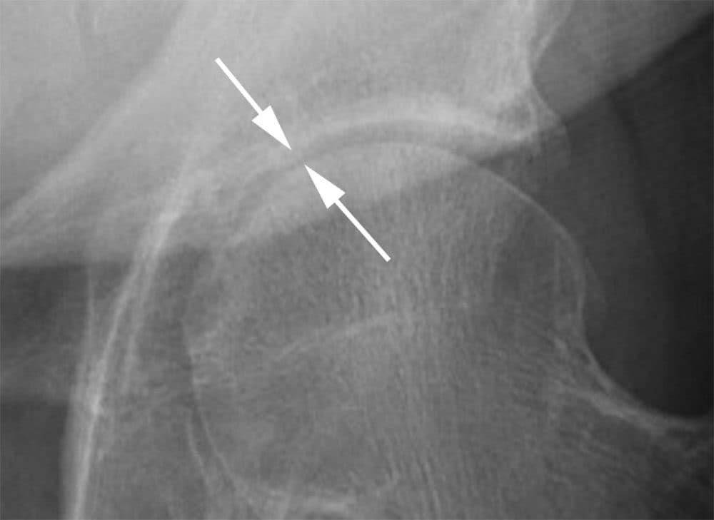This image, from a study in the journal Radiology on how steroid injections affected arthritis in patients' hips and knees, shows the hip of a patient referred for an injection; it later got much worse. (Courtesy Radiological Society of North America)