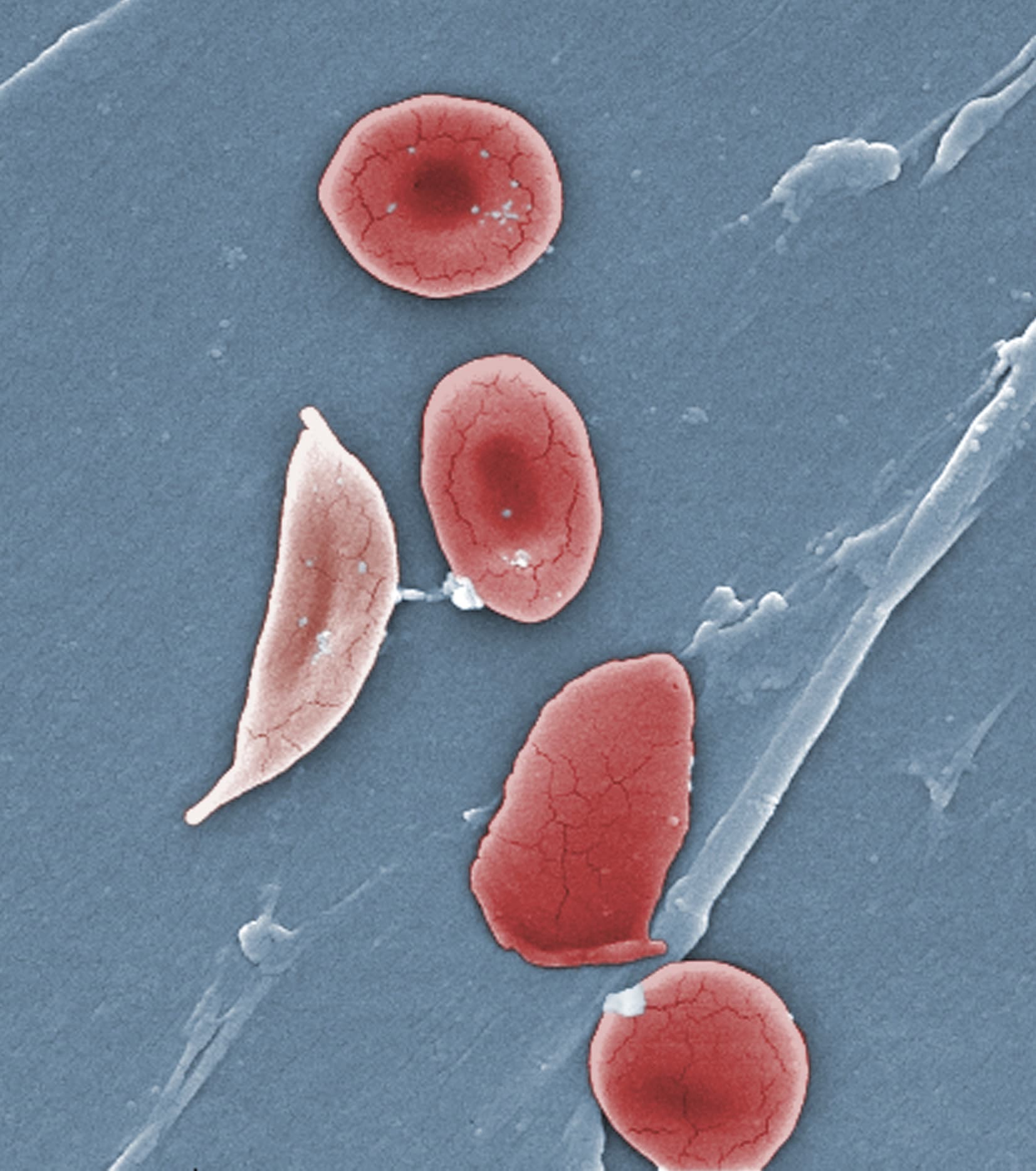 This 2009 colorized microscope image made available by the Sickle Cell Foundation of Georgia via the Centers for Disease Control and Prevention shows a sickle cell, left, and normal red blood cells of a patient with sickle cell anemia. (Janice Haney Carr/CDC/Sickle Cell Foundation of Georgia via AP)