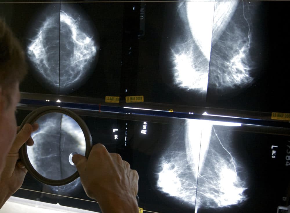 A radiologist uses a magnifying glass to check mammograms for breast cancer. (Damian Dovarganes/AP)