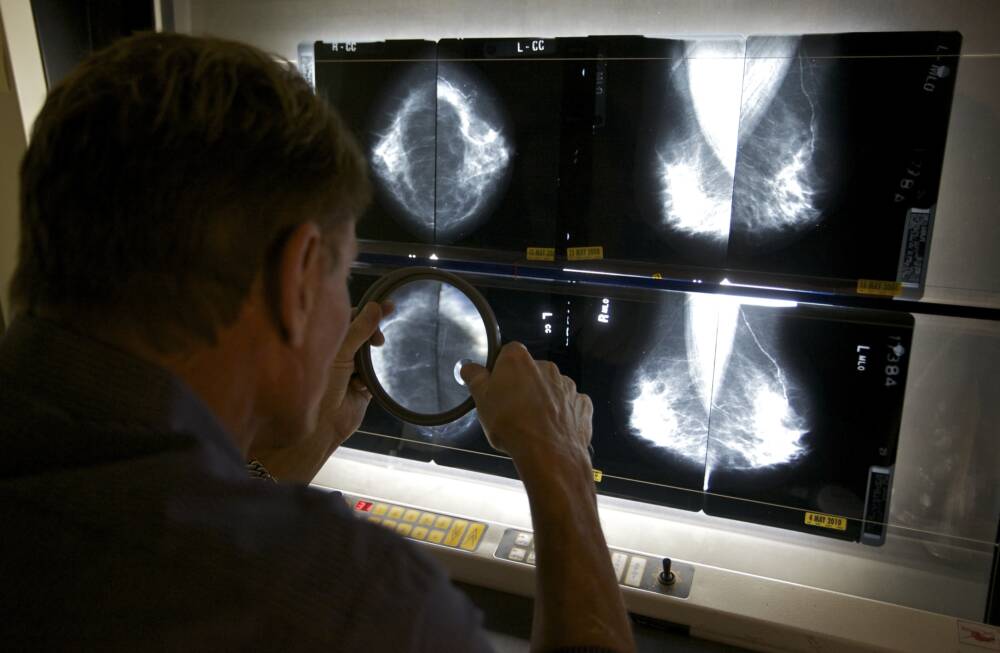 Medical Director Radiologist, Dr. Gerald Iba, checks mammograms, an advanced imaging screening that promotes early detection of breast cancer. (Damian Dovarganes/AP)