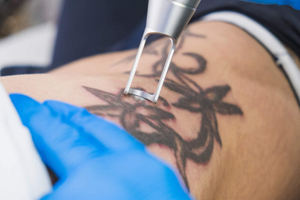 Professional removing tattoo by laser inside a clinic. (Getty Images)